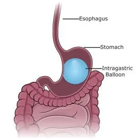 ORBERA intragastric balloon diagram